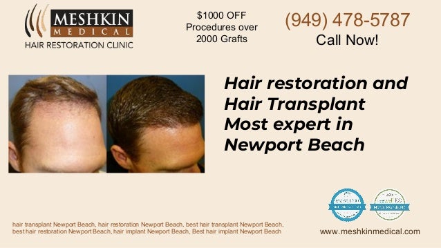 Best Hair Transplant Newport Beach Best Hair Transplant Newport Beach