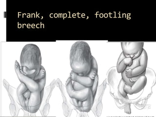 Fetal Attitude or Posture or
habitus
 As a rule, the fetus forms an ovoid mass that
  corresponds roughly to the shape of...