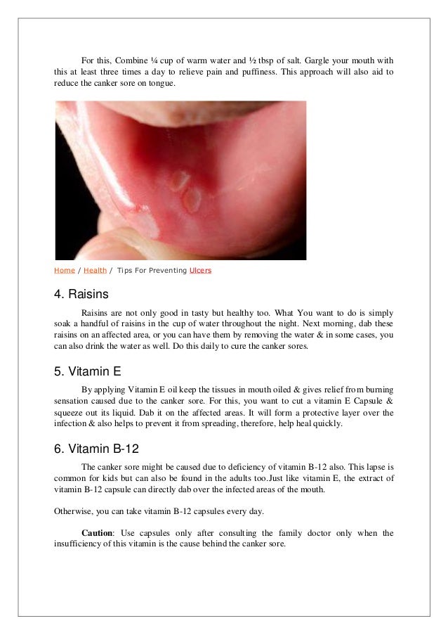 Natural Remedies For Mouth Sores From Braces Natural Remedies For Mouth Sores From Braces