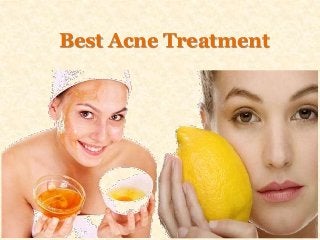 Best Acne Treatment
 