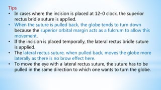 Tips
• In cases where the incision is placed at 12–0 clock, the superior
rectus bridle suture is applied.
• When the suture is pulled back, the globe tends to turn down
because the superior orbital margin acts as a fulcrum to allow this
movement.
• If the incision is placed temporally, the lateral rectus bridle suture
is applied.
• The lateral rectus suture, when pulled back, moves the globe more
laterally as there is no brow effect here.
• To move the eye with a lateral rectus suture, the suture has to be
pulled in the same direction to which one wants to turn the globe.
 