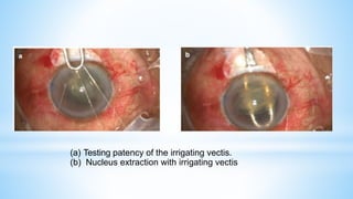 (a) Testing patency of the irrigating vectis.
(b) Nucleus extraction with irrigating vectis
 
