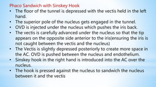 Phaco Sandwich with Sinskey Hook
• The floor of the tunnel is depressed with the vectis held in the left
hand.
• The superior pole of the nucleus gets engaged in the tunnel.
• OVD is injected under the nucleus which pushes the iris back.
• The vectis is carefully advanced under the nucleus so that the tip
appears on the opposite side anterior to the iris(ensuring the iris is
not caught between the vectis and the nucleus)
• The Vectis is slightly depressed posteriorly to create more space in
the AC. OVD is pushed between the nucleus and endothelium.
• Sinskey hook in the right hand is introduced into the AC over the
nucleus.
• The hook is pressed against the nucleus to sandwich the nucleus
between it and the vectis
 