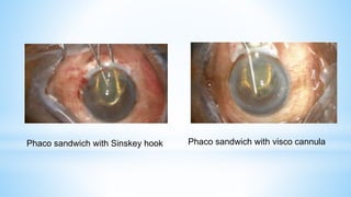 Phaco sandwich with Sinskey hook Phaco sandwich with visco cannula
 