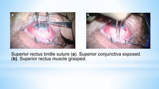 Superior rectus bridle suture (a). Superior conjunctiva exposed.
(b). Superior rectus muscle grasped.
 