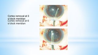 Cortex removal at 3
o’clock meridian
Cortex removal at 6
o’clock meridian
 