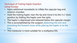 Technique of Trailing Haptic Insertion
Using Forceps
• Inject additional viscoelastic to inflate the capsular bag and
anterior chamber.
• Hold the trailing haptic near the tip and move it to the 3 o’ clock
position by folding the haptic over the optic.
• The haptic is depressed and released below the capsular margin
• This is accomplished by the surgeon abducting the arm and
pronating the forearm more while placing the haptic in to the
bag.
• This maneuver is more suitable for a multipiece IOL.
 