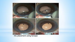 IOL placement using forceps
 
