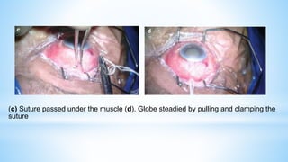 (c) Suture passed under the muscle (d). Globe steadied by pulling and clamping the
suture
 