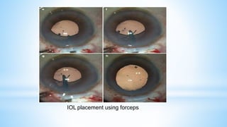 IOL placement using forceps
 