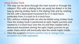 Using Sinskey Hook
• This step can be done through the main tunnel or through the
sideport. IOLs with a dialing hole can easily be dialed in to the
bag by placing sinskey hook in the dialing hole and by rotating
the IOL with a downward movement for 2–3 clock hours
preferably from 3 o’clock to 6 o’clock hour .
• IOLs without a dialing hole can also be dialed using sinskey hook.
Here the sinskey hook is positioned at optic-haptic junction and
rotated to 3 o’clock hour over the iris and then rotated with a
downward movement aiming the optic-haptic junction to go
under rhexis which will eventually take the whole haptic inside.
• Here the surgeon’s forearm position has to change from
pronation to a little supination.
 