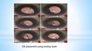 IOL placement using sinskey book
 