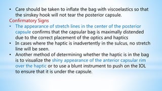 • Care should be taken to inflate the bag with viscoelastics so that
the sinskey hook will not tear the posterior capsule.
Confirmatory Signs
• The appearance of stretch lines in the center of the posterior
capsule confirms that the capsular bag is maximally distended
due to the correct placement of the optics and haptics
• In cases where the haptic is inadvertently in the sulcus, no stretch
line will be seen.
• Another method of determining whether the haptic is in the bag
is to visualize the shiny appearance of the anterior capsular rim
over the haptic or to use a blunt instrument to push on the IOL
to ensure that it is under the capsule.
 