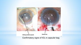 Confirmatory signs of IOL in capsular bag
 