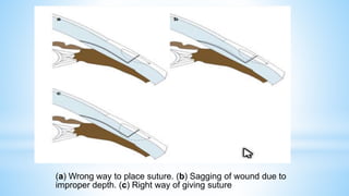 (a) Wrong way to place suture. (b) Sagging of wound due to
improper depth. (c) Right way of giving suture
 