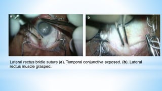 Lateral rectus bridle suture (a). Temporal conjunctiva exposed. (b). Lateral
rectus muscle grasped.
 