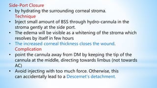 Side-Port Closure
• by hydrating the surrounding corneal stroma.
Technique
• Inject small amount of BSS through hydro-cannula in the
stroma gently at the side port.
• The edema will be visible as a whitening of the stroma which
resolves by itself in few hours
• The increased corneal thickness closes the wound.
Complication
• point the cannula away from DM by keeping the tip of the
cannula at the middle, directing towards limbus (not towards
AC)
• Avoid injecting with too much force. Otherwise, this
can accidentally lead to a Descemet’s detachment.
 