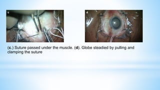 (c.) Suture passed under the muscle. (d). Globe steadied by pulling and
clamping the suture
 