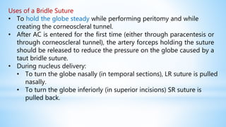Uses of a Bridle Suture
• To hold the globe steady while performing peritomy and while
creating the corneoscleral tunnel.
• After AC is entered for the first time (either through paracentesis or
through corneoscleral tunnel), the artery forceps holding the suture
should be released to reduce the pressure on the globe caused by a
taut bridle suture.
• During nucleus delivery:
• To turn the globe nasally (in temporal sections), LR suture is pulled
nasally.
• To turn the globe inferiorly (in superior incisions) SR suture is
pulled back.
 