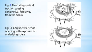 Fig. 2 Illustrating vertical
traction causing
conjunctival fold away
from the sclera
Fig. 3 Conjunctival/tenon
opening with exposure of
underlying sclera
 