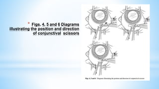 * Figs. 4, 5 and 6 Diagrams
illustrating the position and direction
of conjunctival scissors
 