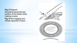 Fig. 8 Diagram
illustrating perpendicular
position of the blade while
making incision
Fig. 9 Non-sagging and
closely apposed incision
 