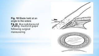 Fig. 10 Blade held at an
angle to the sclera
F
r
e
i
g
s
u
.
l
1
t
i
1
n
g
A
n
i
n
a
w
n
o
g
u
l
e
n
d
d
w
g
o
a
u
p
n
e
d
following surgical
maneuvering
 