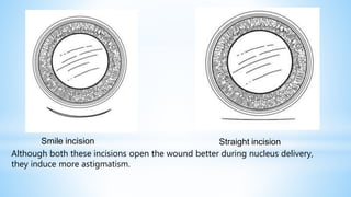 Straight incision
Although both these incisions open the wound better during nucleus delivery,
they induce more astigmatism.
Smile incision
 