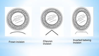 Chevron
incision
Inverted batwing
incision
Frown incision
 