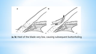(a, b) Heel of the blade very low, causing subsequent buttonholing
 