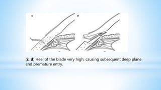 (c, d) Heel of the blade very high, causing subsequent deep plane
and premature entry.
 