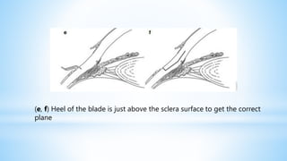 (e, f) Heel of the blade is just above the sclera surface to get the correct
plane
 