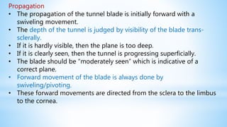 Propagation
• The propagation of the tunnel blade is initially forward with a
swiveling movement.
• The depth of the tunnel is judged by visibility of the blade trans-
sclerally.
• If it is hardly visible, then the plane is too deep.
• If it is clearly seen, then the tunnel is progressing superficially.
• The blade should be “moderately seen” which is indicative of a
correct plane.
• Forward movement of the blade is always done by
swiveling/pivoting.
• These forward movements are directed from the sclera to the limbus
to the cornea.
 