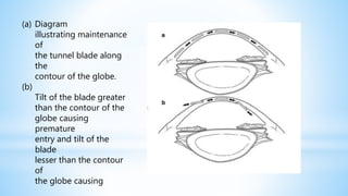 (a) Diagram
illustrating maintenance
of
the tunnel blade along
the
(b)
contour of the globe.
Tilt of the blade greater
than the contour of the
globe causing
premature
entry and tilt of the
blade
lesser than the contour
of
the globe causing
 