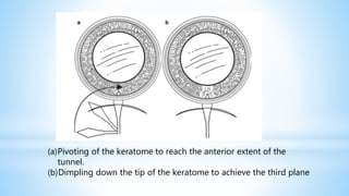 (a)Pivoting of the keratome to reach the anterior extent of the
tunnel.
(b)Dimpling down the tip of the keratome to achieve the third plane
 