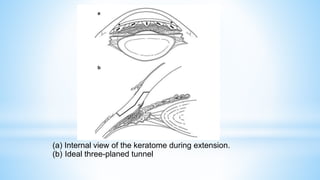 (a) Internal view of the keratome during extension.
(b) Ideal three-planed tunnel
 