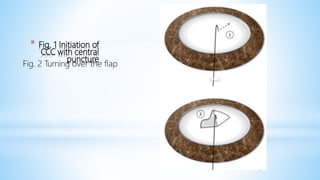 * Fig. 1 Initiation of
CCC with central
puncture
Fig. 2 Turning over the flap
 