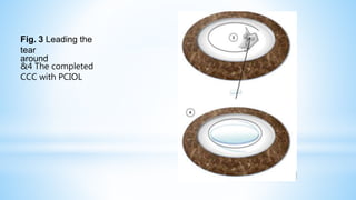 Fig. 3 Leading the
tear
around
&4 The completed
CCC with PCIOL
 