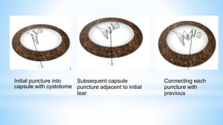 Initial puncture into
capsule with cystotome
Subsequent capsule
puncture adjacent to initial
tear
Connecting each
puncture with
previous
 