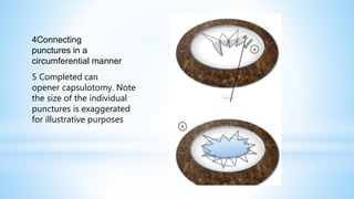 4Connecting
punctures in a
circumferential manner
5 Completed can
opener capsulotomy. Note
the size of the individual
punctures is exaggerated
for illustrative purposes
 