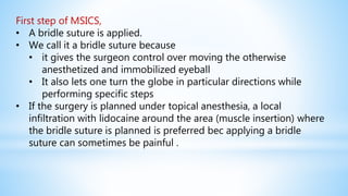 First step of MSICS,
• A bridle suture is applied.
• We call it a bridle suture because
• it gives the surgeon control over moving the otherwise
anesthetized and immobilized eyeball
• It also lets one turn the globe in particular directions while
performing specific steps
• If the surgery is planned under topical anesthesia, a local
infiltration with lidocaine around the area (muscle insertion) where
the bridle suture is planned is preferred bec applying a bridle
suture can sometimes be painful .
 