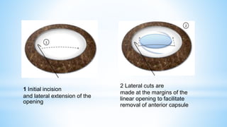 1 Initial incision
and lateral extension of the
opening
2 Lateral cuts are
made at the margins of the
linear opening to facilitate
removal of anterior capsule
 