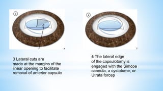 4 The lateral edge
of the capsulotomy is
engaged with the Simcoe
cannula, a cystotome, or
Utrata forcep
3 Lateral cuts are
made at the margins of the
linear opening to facilitate
removal of anterior capsule
 