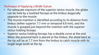Technique of Applying a Bridle Suture
• For adequate exposure of the superior rectus muscle, the globe
can be held by a toothed forceps at the limbus diagonally
opposite to the muscle
• The muscle insertion is identified according to its distance from
limbus (either superior 7.7 mm or temporal 6.9 mm), and the
muscle is grasped just beyond the insertion with the superior
rectus holding forceps.
• Superior rectus holding forceps has a double curve at the end.
When the proximal bent is placed at the limbus, the distal bent at
the tip will be at 7.7 mm from the limbus to catch muscle with its
single large tooth at the tip
 