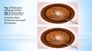Fig. 3 Fluid wave
advances further
F
ab
ig
o
.
u
4
t
F
to
lu
c
id
ro
w
ss
av
th
e
e
is
posterior plane
of the lens and reach
the equator
 
