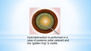 Hydrodelineation is performed in a
case of posterior polar cataract and
the “golden ring” is visible
 