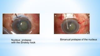 Nucleus prolapse
with the Sinskey hook
Bimanual prolapse of the nucleus
 