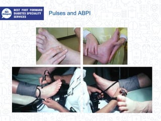 Pulses and ABPI
 
