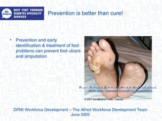Prevention is better than cure!
• Prevention and early
identification & treatment of foot
problems can prevent foot ulcers
and amputation
DPMI Workforce Development – The Alfred Workforce Development Team
June 2005
So urce : Fo o tcare in Diabe te s Wo rkbo o k fo rHe alth ro fe ssio nals .
Australian Diabetes Educators Association
 