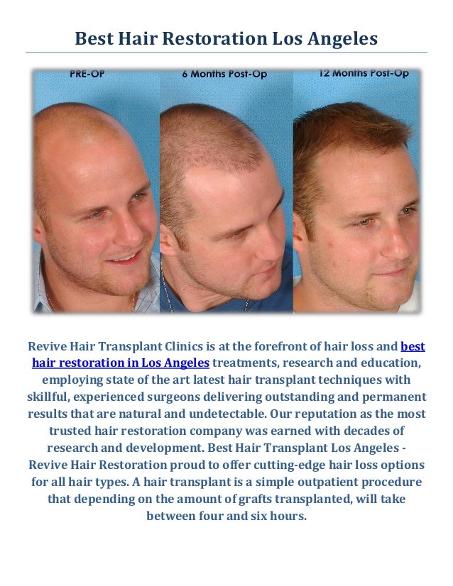Best Hair Restoration : Hair Transplant Los Angeles CA